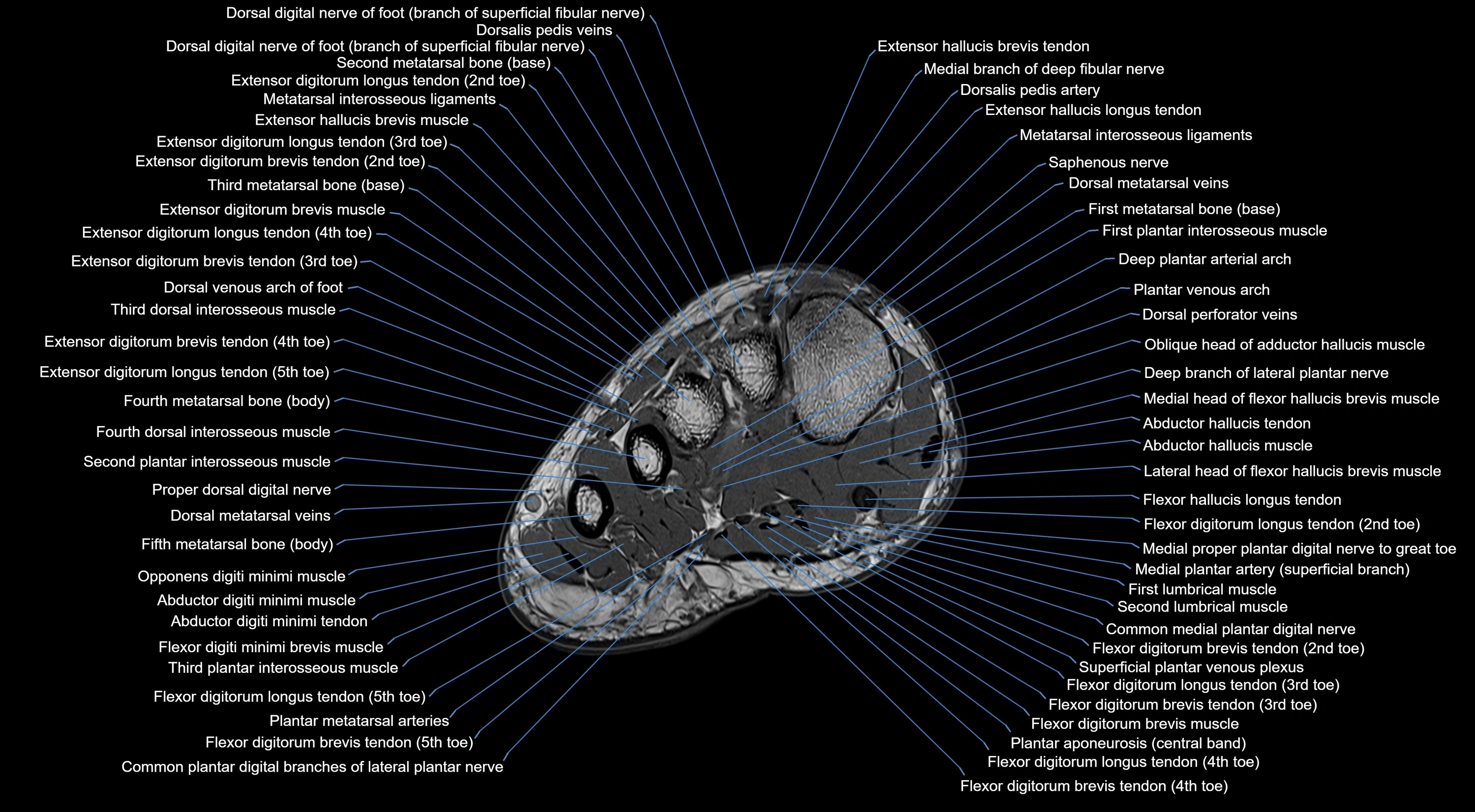 MRI mid foot coronal ligaments cross sectional anatomy 3T  radiology  image-img-00001-00010.webp